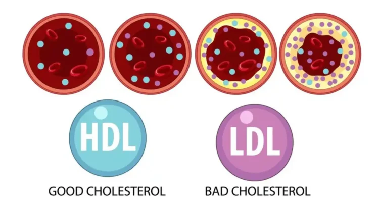 Apa Itu Kolesterol Jahat
