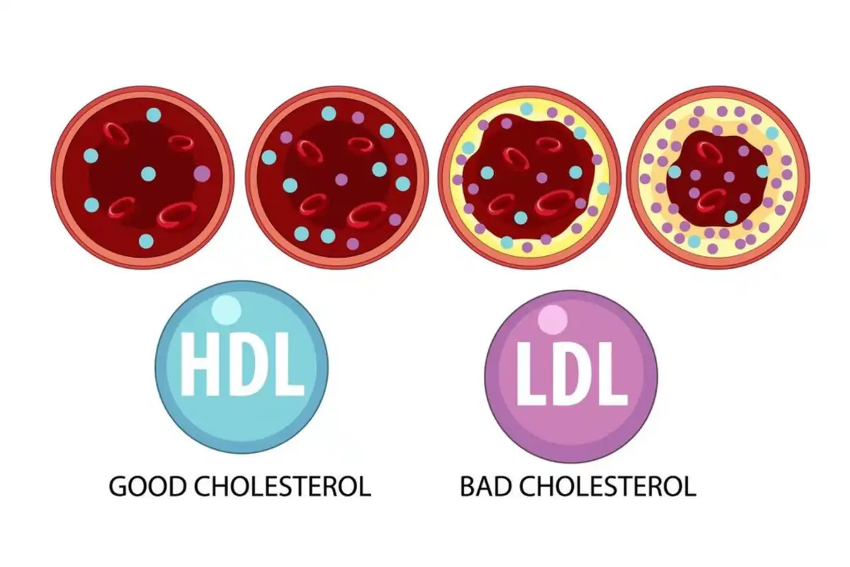 Apa Itu Kolesterol Jahat