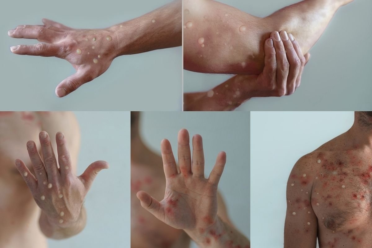 Mpox